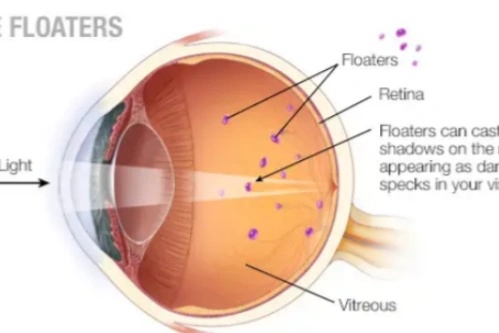 飞蚊症原理示意图