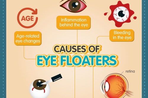 飞蚊症原因示意图