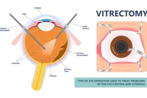 玻璃体切除手术示意图 玻璃体切除手术示意图