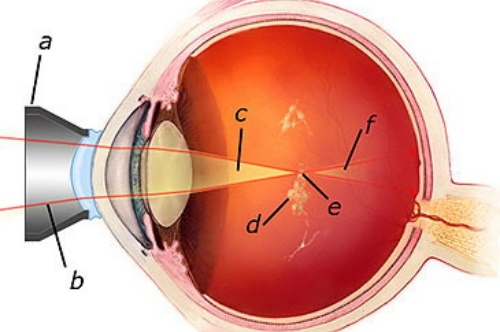 飞蚊症激光手术