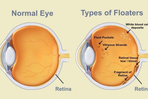 飞蚊症和玻璃体混浊是一回事吗？解开迷雾的健康疑问