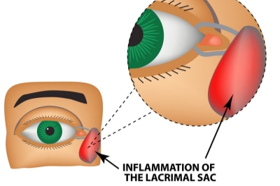 不容错过：泪囊炎手术多少钱全解析，附泪囊炎症状！
