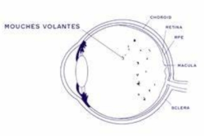 爱尔眼科飞蚊症消融术收费：了解项目及费用差异