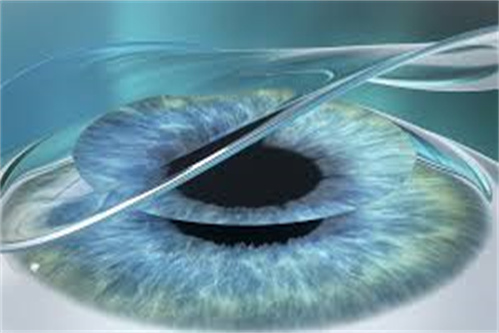 半飞秒手术示意图 半飞秒手术示意图