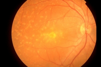 眼底黄斑 眼底黄斑