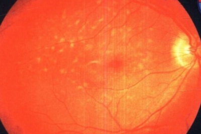 眼部黄斑 眼部黄斑