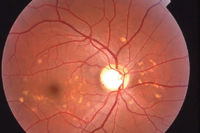 眼底黄斑 眼底黄斑