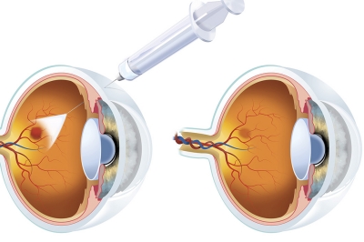 眼底黄斑针 眼底黄斑针