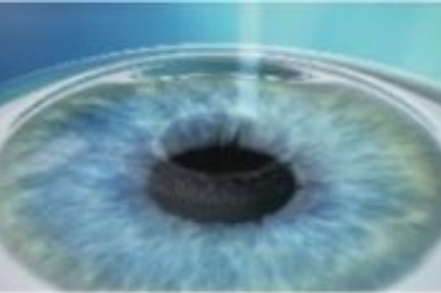 全飞秒手术示意图