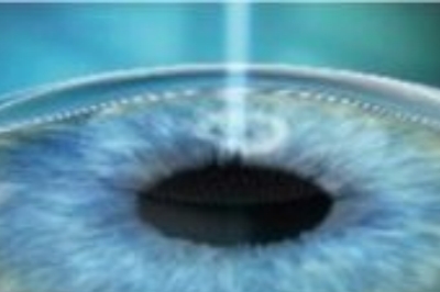 全飞秒手术示意图