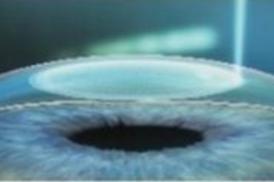 全飞秒手术示意图