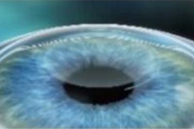 全飞秒手术过程