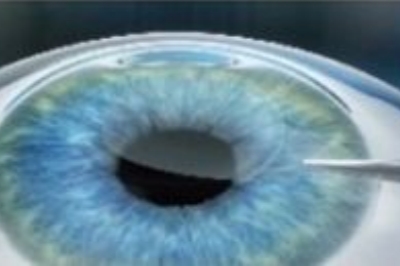 全飞秒手术示意图