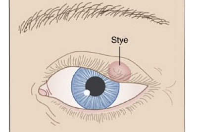 麦粒肿示意图 麦粒肿示意图