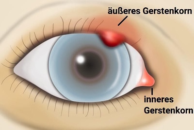 麦粒肿示意图 麦粒肿示意图