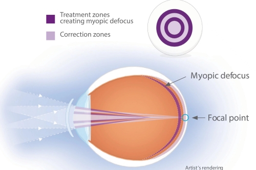 离焦软镜原理示意图