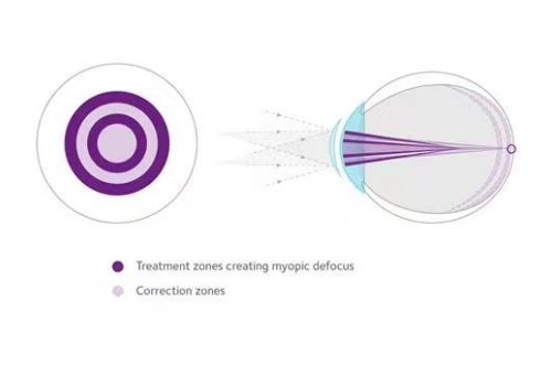 离焦软镜示意图