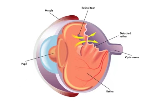 视网膜脱落动画示意图