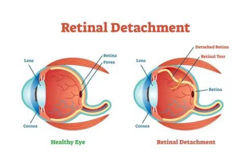 视网膜脱落与正常对比图