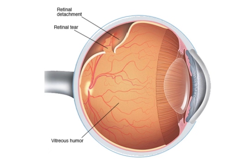 视网膜脱落示意图