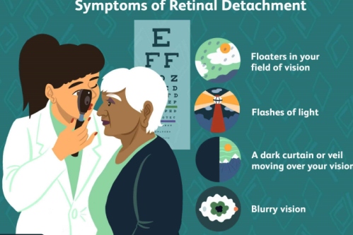 视网膜脱落的症状示意图