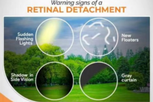 视网膜脱落症状示意图