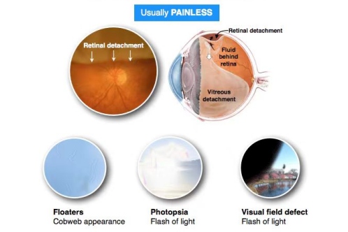 视网膜脱落症状示意图