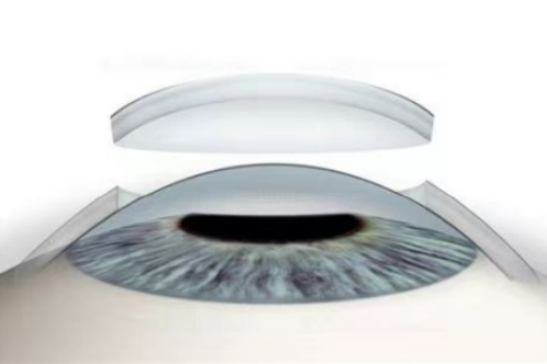 快问快答：角膜移植手术有风险吗？有哪些？能维持几年？