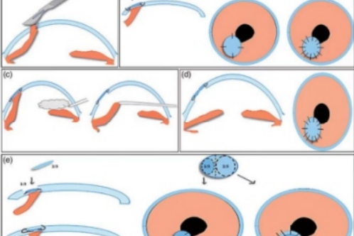角膜移植手术示意图