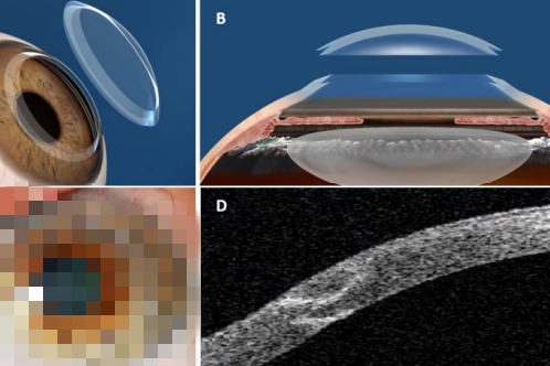 角膜移植手术示意图