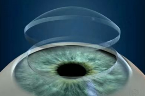 角膜移植手术示意图