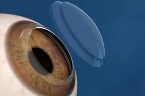 角膜移植手术示意图