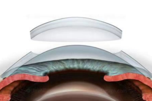 角膜移植手术示意图