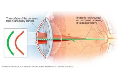 散光示意图 散光示意图