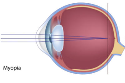 假性近视的10个征兆：揭开这个视力障碍的迷雾
