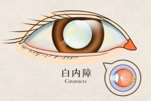 白内障动画示意图