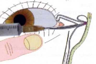 泪道探通手术 泪道探通手术