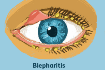 干眼症用什么药好使？可以做手术治疗好吗？手术费用多少？