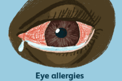 干眼症症状示意图