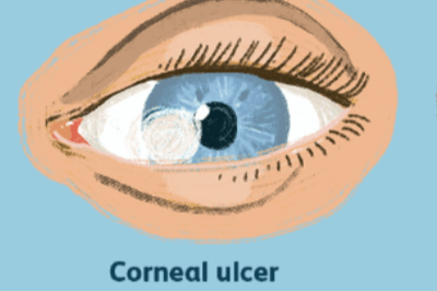干眼症症状示意图