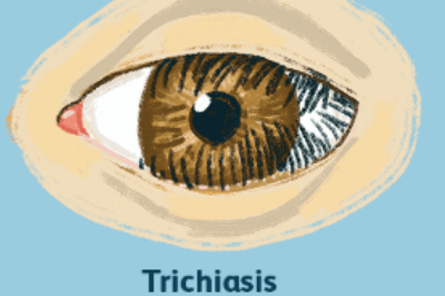 干眼症症状示意图
