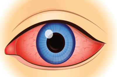 干眼症有哪些临床表现？发病原因是什么？可以完全恢复吗？