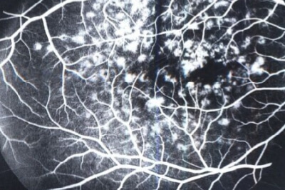 眼底黄斑针治疗：5000元一针，真的吗？需要打几针？