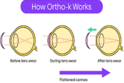 角膜塑形镜矫正原理