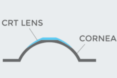 角膜塑形镜受力示意图