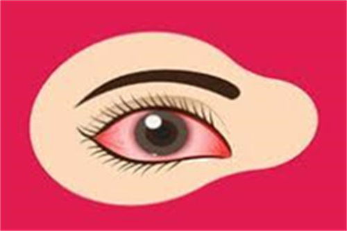 干眼症症状表现示意图 干眼症症状表现示意图