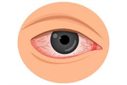 干眼症状示意图