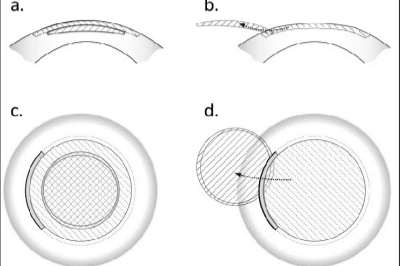 全飞秒手术示意图