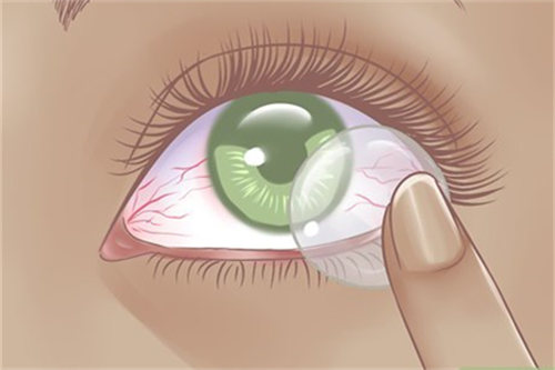 隐形眼镜佩戴示意图 隐形眼镜佩戴示意图