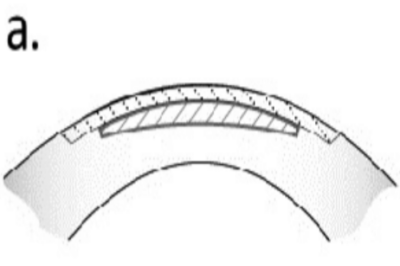 全飞秒手术示意图